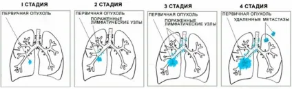 Свист в носі при диханні у дорослого і дитини причини і чим лікувати (свист) Свист в носі при диханні у дорослого і дитини причини і чим лікувати