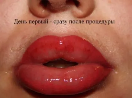Татуаж губ - догляд після процедури за рекомендацією лікаря і косметолога