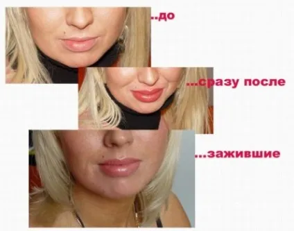 Татуаж губ - догляд після процедури за рекомендацією лікаря і косметолога