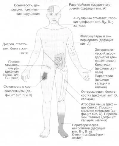 Терапія-синдром мальабсорбції клініка діагностика, і лікування - медична енциклопедія (клініка) Терапія-синдром мальабсорбції клініка діагностика, і лікування - медична енциклопедія