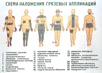 Техніка проведення грязьових аплікацій (техніка) Техніка проведення грязьових аплікацій