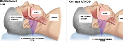 Хропіння і як від нього позбутися, для наших чоловіків