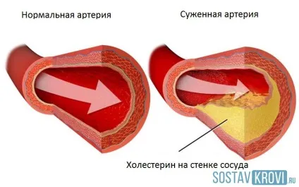 Холестеринові бляшки поганий і хороший холестерин в судинах, на обличчі, лікування, як боротися