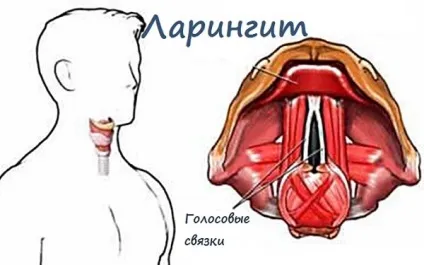 Хронічний гіперпластичний і гіпертрофічний ларингіт (ларингіт) Хронічний гіперпластичний і гіпертрофічний ларингіт