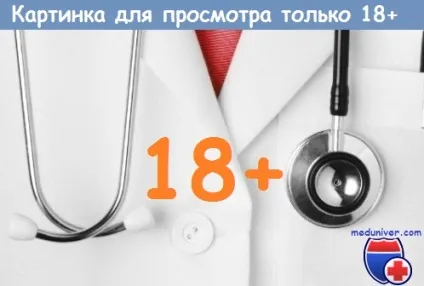 Хронічний гіперпластичний ларингіт