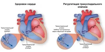 Трикуспидальная регургітація симптоми, діагностика та лікування (регургітація) Трикуспидальная регургітація симптоми, діагностика та лікування
