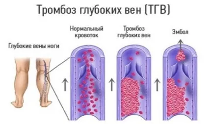Тромбоз вен нижніх кінцівок симптоми, лікування, чим небезпечний (тромбоз) Тромбоз вен нижніх кінцівок симптоми, лікування, чим небезпечний