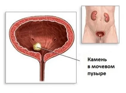 Видалення каменів з сечового міхура у чоловіків основні методи (каменів) Видалення каменів з сечового міхура у чоловіків основні методи