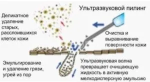 Ультразвукова чистка обличчя коли можна робити, процедура і протипоказання (особи) Ультразвукова чистка обличчя коли можна робити, процедура і протипоказання