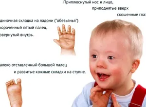 Уреаплазма у жінок - симптоми і лікування (лікування) Уреаплазма у жінок - симптоми і лікування