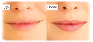 Догляд за губами після татуажу ніж мазати (татуаж губ догляд після процедури) Догляд за губами після татуажу ніж мазати