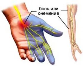 вертеброгенна цервікобрахіалгіі