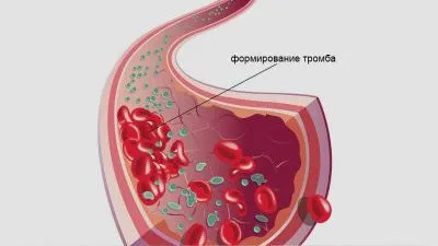 Венарус протипоказання