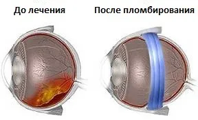 Види операцій при відшаруванні сітківки - відновлення зору, прогноз
