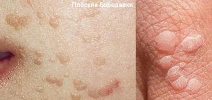 Види бородавок і кондилом на обличчі, руках і тілі людини (види) Види бородавок і кондилом на обличчі, руках і тілі людини