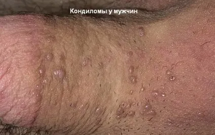 Види бородавок і кондилом на обличчі, руках і тілі людини (бородавки види вульгарні які бувають фото) Види бородавок і кондилом на обличчі, руках і тілі людини