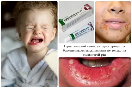 Види стоматиту у дітей, симптоми, лікування відео (здоров'я дитини) Види стоматиту у дітей, симптоми, лікування відео