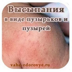 Висипання у вигляді бульбашок і бульбашок