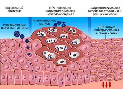 Вірус папіломи людини у чоловіків лікування, причини та симптоми (людини) Вірус папіломи людини у чоловіків лікування, причини та симптоми