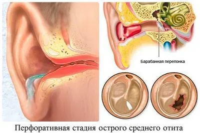 Запалення лімфовузлів біль віддає в вухо (того чому болить) Запалення лімфовузлів біль віддає в вухо