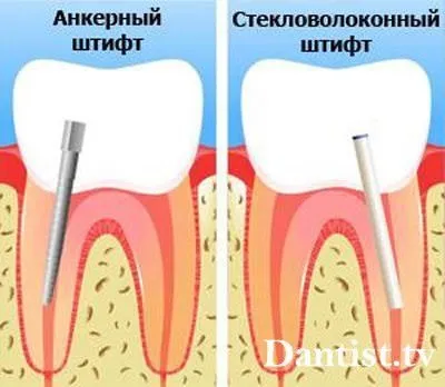 Відновлення зуба (зубів) ціна і фото (більш серйозні руйнування) Відновлення зуба (зубів) ціна і фото