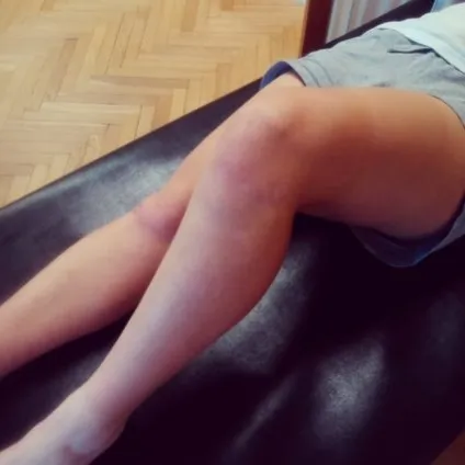 Запалення зв'язок колінного суглоба, причини та методи лікування (колінного) Запалення зв'язок колінного суглоба, причини та методи лікування