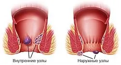 Час лікування геморою