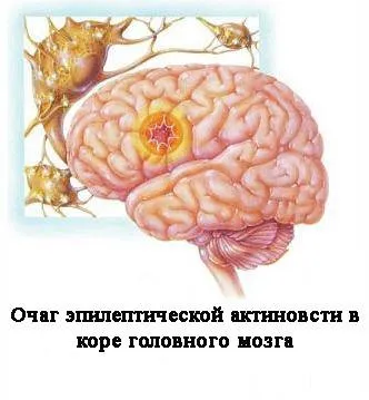 Все про епілепсію