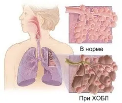 ХОЗЛ - симптоми, лікування народними засобами в домашніх умовах, дихальна гімнатсіка (лікування) ХОЗЛ - симптоми, лікування народними засобами в домашніх умовах, дихальна гімнатсіка