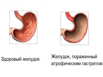 Хронічний вогнищевий атрофічний гастрит - лікування (гастрит) Хронічний вогнищевий атрофічний гастрит - лікування