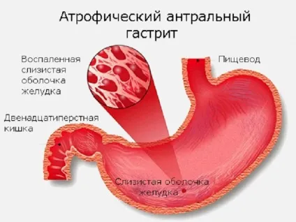Хронічний вогнищевий атрофічний гастрит - лікування (хронічний) Хронічний вогнищевий атрофічний гастрит - лікування