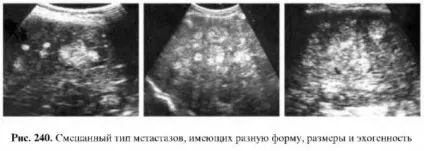 Захворювання печінки - узі (альвеолярний гідатівний ехінокок) Захворювання печінки - узі
