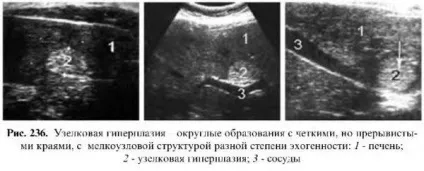Захворювання печінки - узі (виділяються навколишнього паренхіми) Захворювання печінки - узі