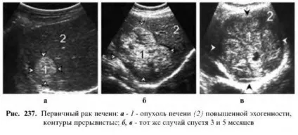 Захворювання печінки - узі (абсцес великовогнищевий цироз) Захворювання печінки - узі