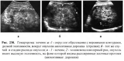 Захворювання печінки - узі (захворювання) Захворювання печінки - узі