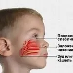 Закладеність вух при застуді - як швидко зняти закладеність народними засобами (застуді) Закладеність вух при застуді - як швидко зняти закладеність народними засобами