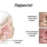 Закладеність вух при застуді - як швидко зняти закладеність народними засобами (застуді) Закладеність вух при застуді - як швидко зняти закладеність народними засобами