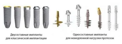 Зубні імпланти - який термін служби (зубні) Зубні імпланти - який термін служби