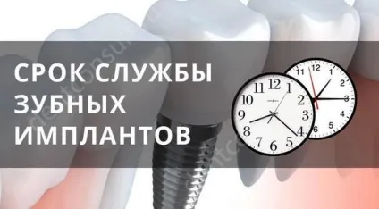 Зубні імпланти - який термін служби (термін) Зубні імпланти - який термін служби