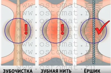 Зубна нитка що це таке, як правильно користуватися, шкода і користь, як вибрати, огляд цін (правильно) Зубна нитка що це таке, як правильно користуватися, шкода і користь, як вибрати, огляд цін