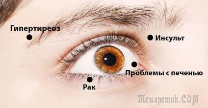 10 Серйозних хвороб, які можна продіагностувати по очах (очам) 10 Серйозних хвороб, які можна продіагностувати по очах