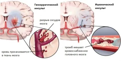 5 Основних симптомів, за якими можна легко розпізнати інсульт (можна) 5 Основних симптомів, за якими можна легко розпізнати інсульт