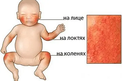 Алергія на шерсть тварин у дітей та дорослих симптоми, лікування та заходи профілактики