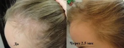 Алерана - шампунь проти випадіння волосся відгуки, склад, ефект зростання волосся (випадання) Алерана - шампунь проти випадіння волосся відгуки, склад, ефект зростання волосся