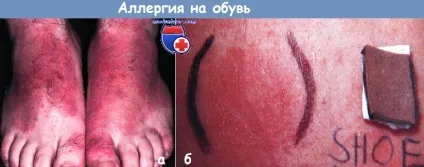 Алергія на взуття
