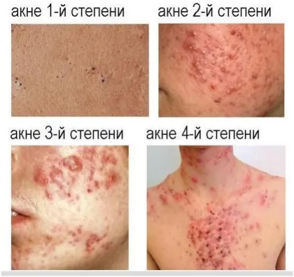Акне 2 ступеня медикаментозні і апаратні методи лікування (лікування) Акне 2 ступеня медикаментозні і апаратні методи лікування