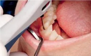 Апарат vector paro pro (новий вектор паро), durr dental (германію) - продаж та обслуговування (castellini) Апарат vector paro pro (новий вектор паро), durr dental (германію) - продаж та обслуговування