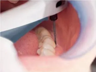 Апарат vector paro pro (новий вектор паро), durr dental (германію) - продаж та обслуговування (стоматологічний лазер) Апарат vector paro pro (новий вектор паро), durr dental (германію) - продаж та обслуговування