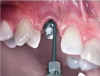 Апарат vector paro pro (новий вектор паро), durr dental (германію) - продаж та обслуговування (новий) Апарат vector paro pro (новий вектор паро), durr dental (германію) - продаж та обслуговування