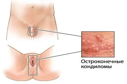 Аногенітальні бородавки причини появи і лікування (аногенітальні) Аногенітальні бородавки причини появи і лікування